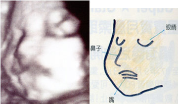 怀孕第9个月(33～36周)图解b超 有些胎儿已经急着和爸妈见面啰!